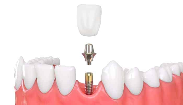 graphic of dental implant being placed into gap in lower set of teeth