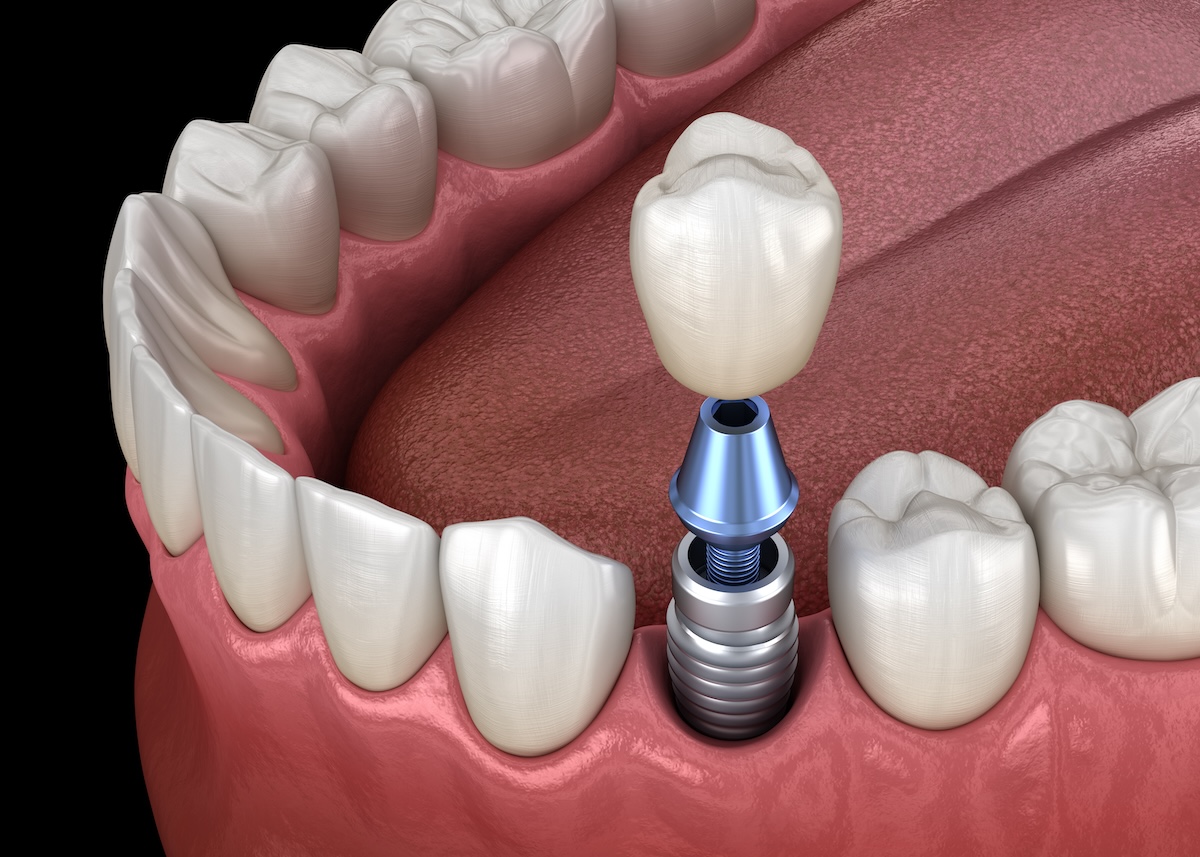 dental implants, dental implants care, how to floss dental implants, dentist in Cary