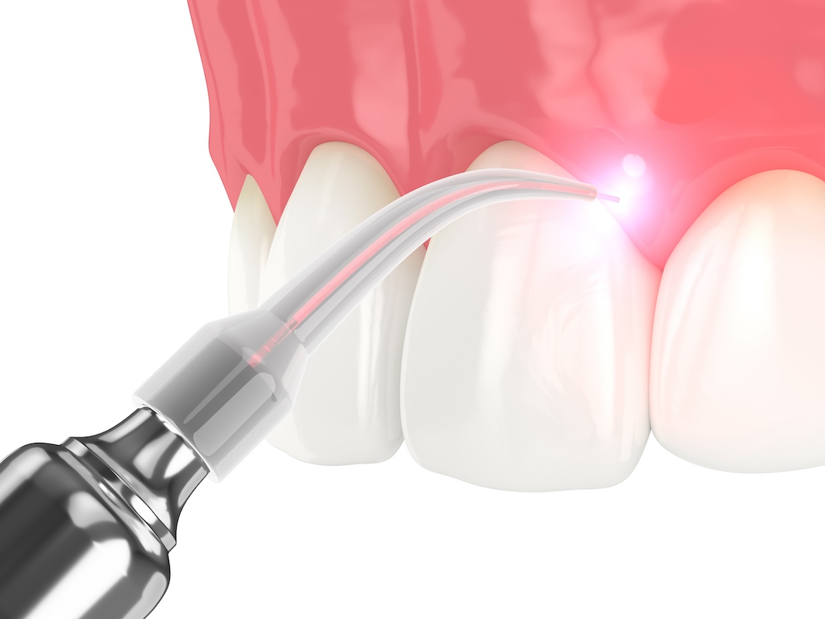 lasers in dentistry, dental laser, dentist in cary