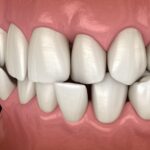 misaligned bite, bite alignment, malocclusion, Cary Family Dental, oral health, TMJ disorders, Dr. Niraj Patel