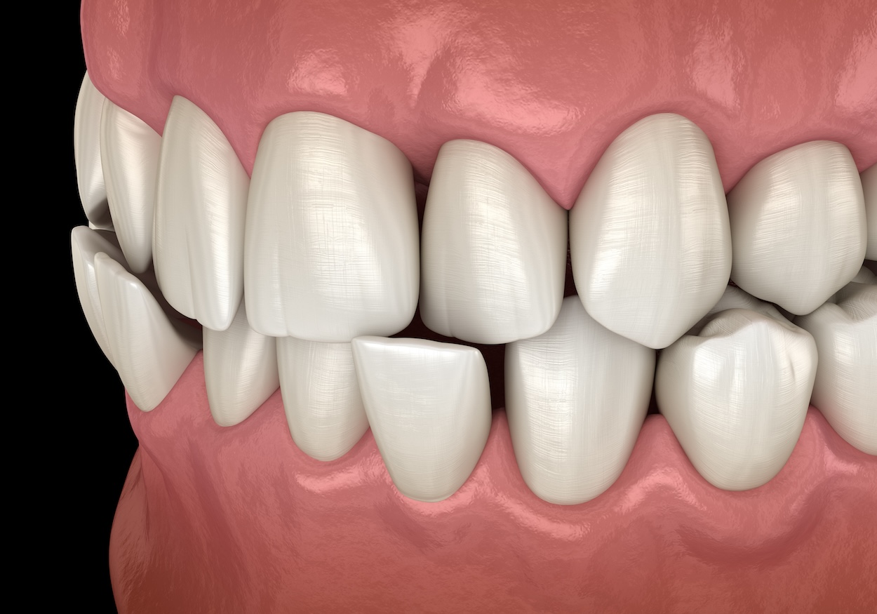 misaligned bite, bite alignment, malocclusion, Cary Family Dental, oral health, TMJ disorders, Dr. Niraj Patel