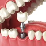 dental implants, Cary Family Dental, Cary IL, Dr. Niraj Patel, tooth replacement, implant-retained dentures, oral health, dental care