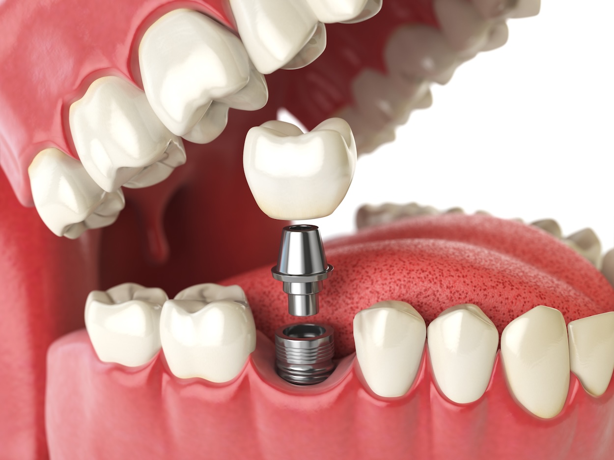 dental implants, Cary Family Dental, Cary IL, Dr. Niraj Patel, tooth replacement, implant-retained dentures, oral health, dental care