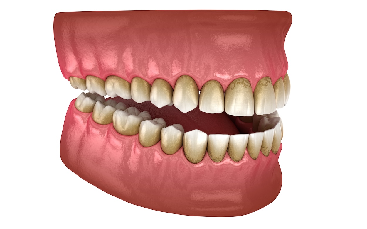 stages of gum disease, gum disease treatment, Cary Family Dentistry, Cary IL dentist, Dr. Niraj Patel, gingivitis, periodontitis, oral health, dental care, gum health