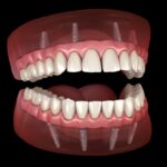 implant supported dentures, dental implants, jawbone health, dentures vs implants, Cary Family Dental, Cary IL