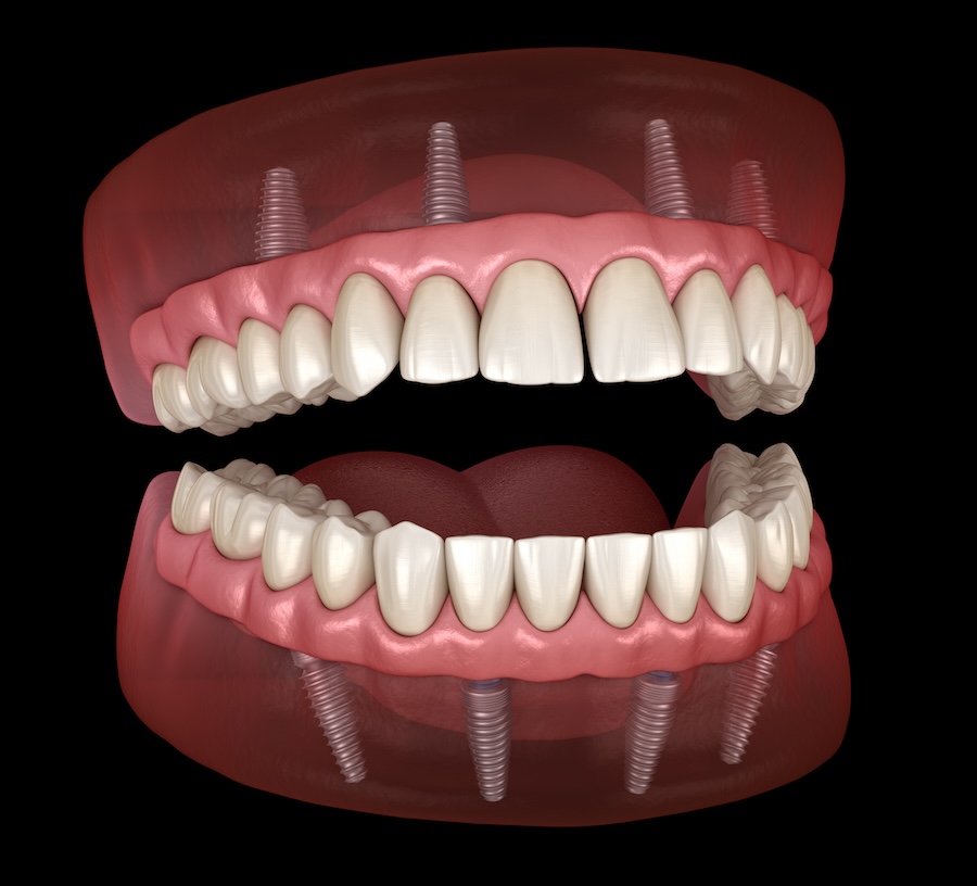 implant supported dentures, dental implants, jawbone health, dentures vs implants, Cary Family Dental, Cary IL