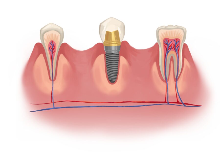 dental implants, tooth replacement, restore smile, Cary Family Dental, Dr. Niraj Patel, Cary IL dentist, dental health benefits, dentist Cary, dentist in Cary, dental implants in Cary