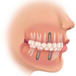 dental implants, missing teeth, tooth replacement, Cary dentist, osseointegration, implant crowns, bone health