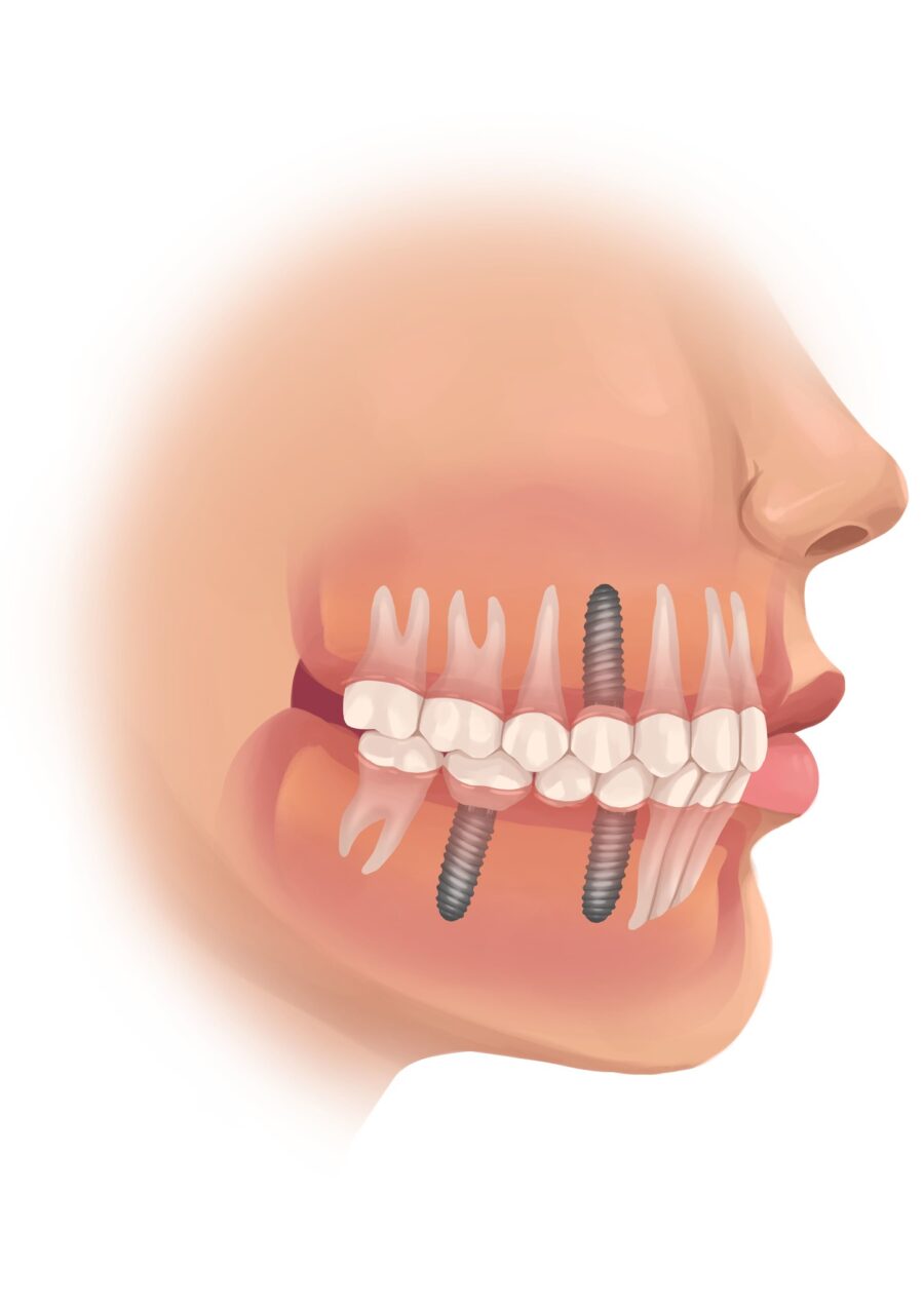 dental implants, missing teeth, tooth replacement, Cary dentist, osseointegration, implant crowns, bone health