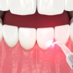 laser gum therapy, LANAP®, gum disease treatment, minimally invasive dentistry, Cary dentist, laser dentistry, gum health