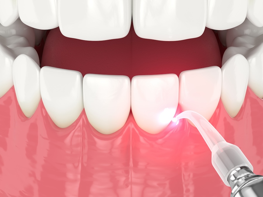 laser gum therapy, LANAP®, gum disease treatment, minimally invasive dentistry, Cary dentist, laser dentistry, gum health