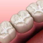 image of dental sealants on molars