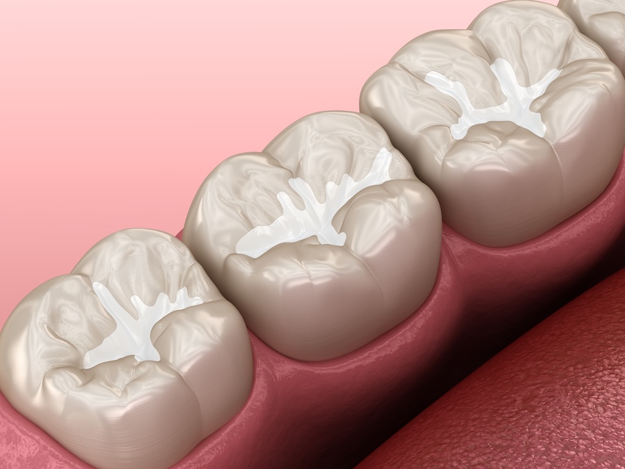 image of dental sealants on molars