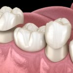 same day dental crowns on premolar and molar teeth