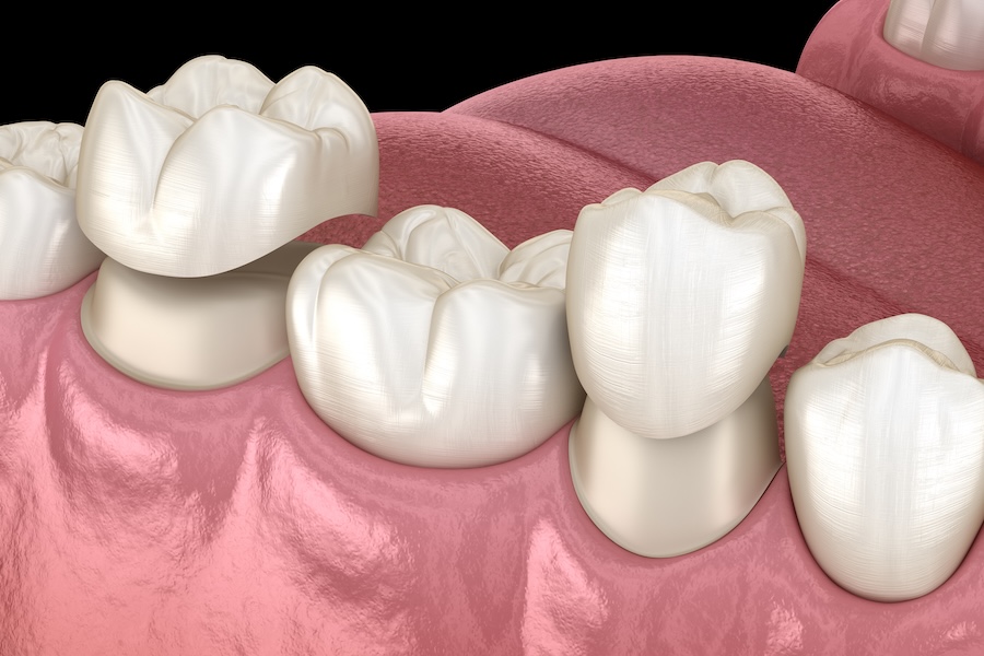 same day dental crowns on premolar and molar teeth