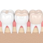 different types of dental restorations, dental fillings, onlay, dental crown