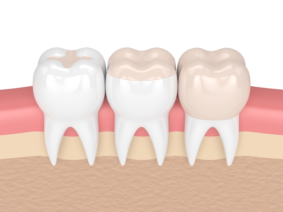 different types of dental restorations, dental fillings, onlay, dental crown