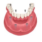 implant supported dentures vs dental implants