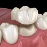 dental crown, CEREC same day dental crown, same day crown