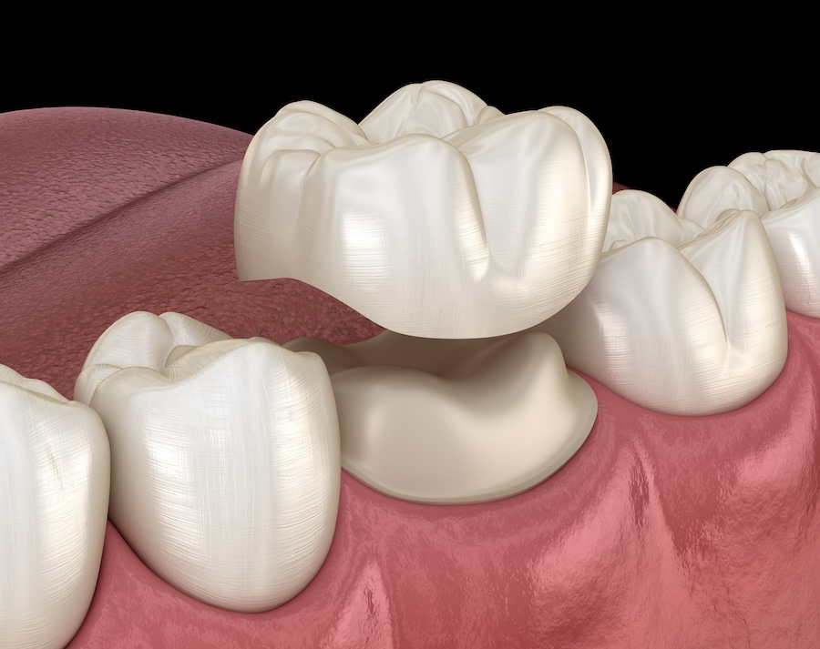 dental crown, CEREC same day dental crown, same day crown