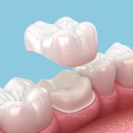 same day dental crown, cerec dental crown