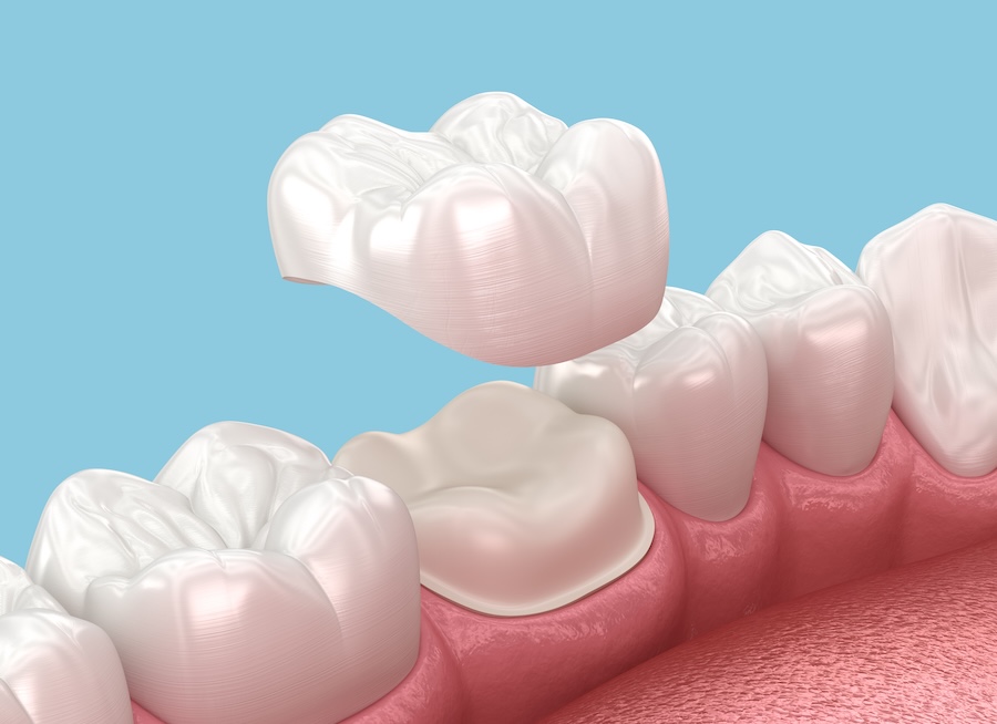 same day dental crown, cerec dental crown