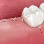 tooth extraction stitches for tooth extraction recovery