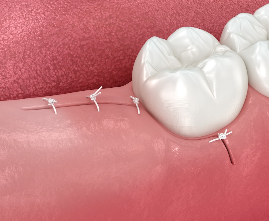 tooth extraction stitches for tooth extraction recovery