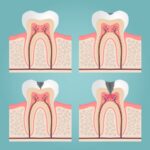decay needing a dental filling