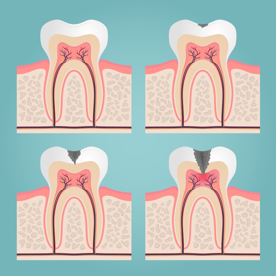 decay needing a dental filling