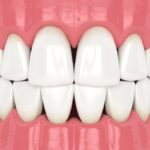 bioclear treatment for black triangles