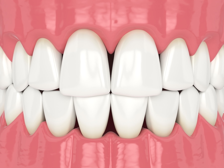 bioclear treatment for black triangles