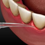 LANAP laser gum therapy for gum disease periodontal therapy deep cleaning