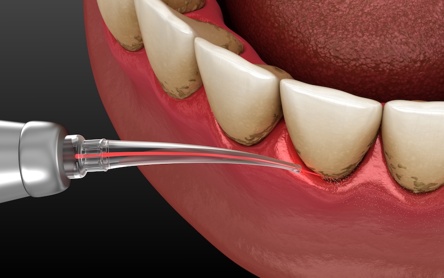 LANAP laser gum therapy for gum disease periodontal therapy deep cleaning