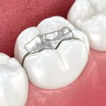 cracked filling, dental emergency, toothaches comes and goes