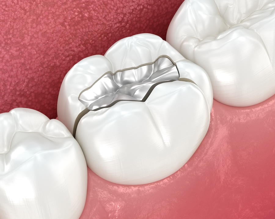 cracked filling, dental emergency, toothaches comes and goes
