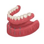 implant supported denture