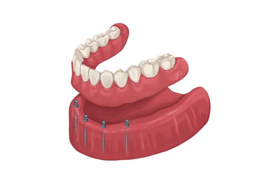 implant supported denture