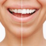 dental veneers before and after