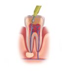 root canal therapy