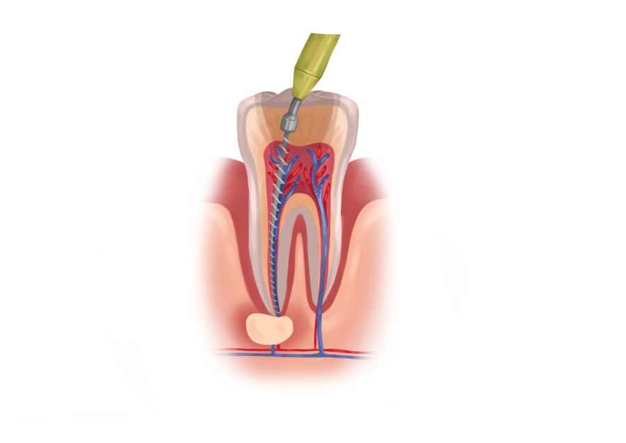 root canal therapy