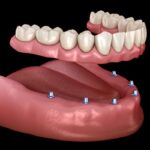 implant supported denture
