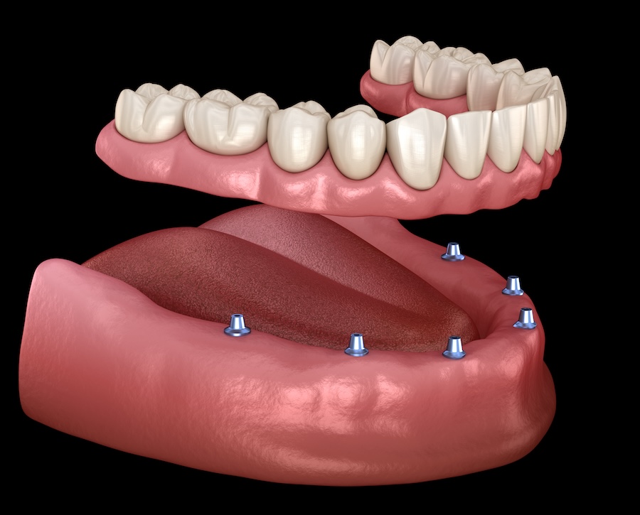 implant supported denture