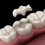 dental inlay