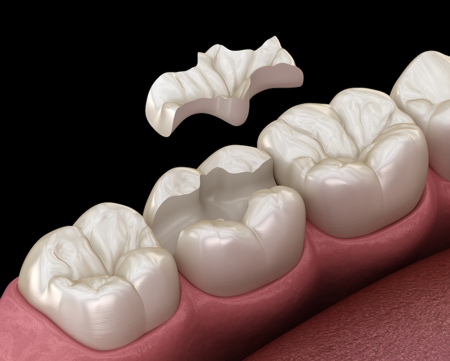 dental inlay