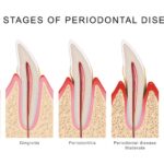 periodontal disease, gum disease, gingivitis, stages