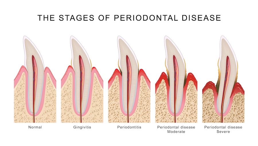 periodontal disease, gum disease, gingivitis, stages
